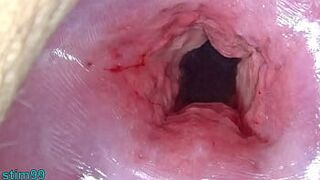 Uncensored Japanese Cervix Stretching and Uterus Dilation with Penetration